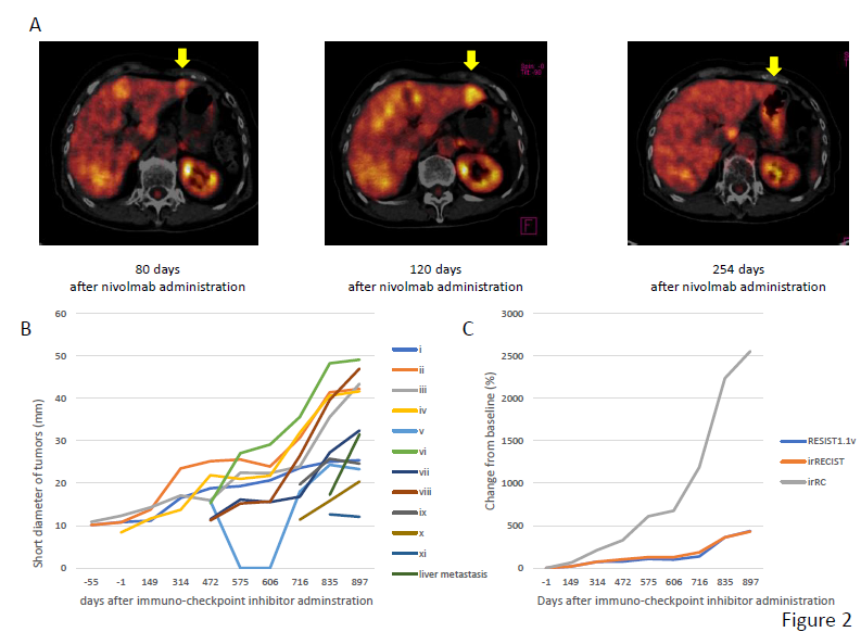 Figure 2: Liver metastasis on PET-CT during nivolumab treatment (A). Changes in tumor size in eleven lung and liver metastases (B). Changes from the baseline as assessed by RECIST, ir-RECIST, and ir-RC(C).
