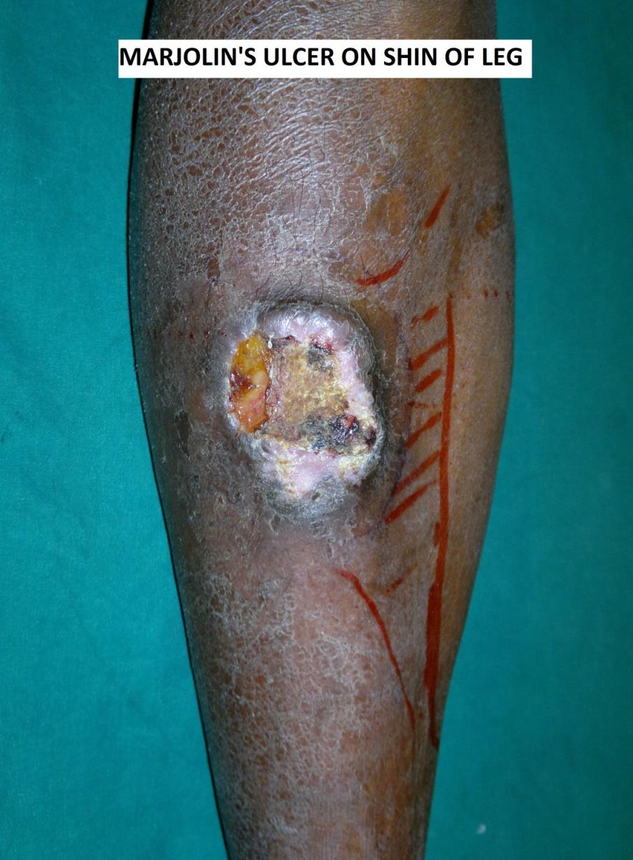 Figure 1: Marjolin’s Ulcer on shin of leg.