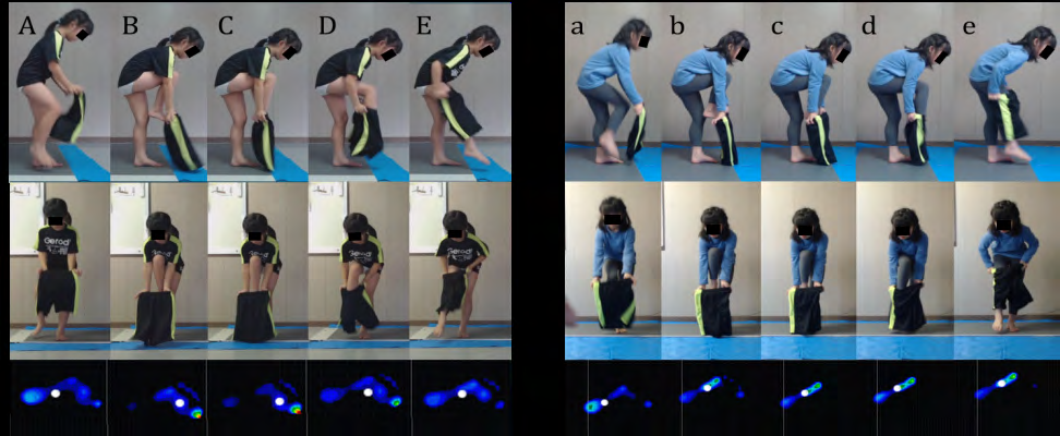 Figure 5: Photographic playback of trouser-wearing motion of participant 1 after the first and fourth OT interventions. The left pictures show the foot of first leg (FL) from the take-off to the landing after the first OT experimental task, whereas the right pictures show the same movements after the fourth OT experimental task. Top photos indicate the sagittal plane; middle, frontal plane; and bottom, foot pressure distribution and the COP of the first support leg (FSL). The dark blue color indicates a weak pressure, whereas the green color indicates a strong pressure. The white circles indicate COP. “A” and “a” show when the FL begins to move. “B” and “b” show when the foot of the FL has reached the waistbandof the trousers. “C” and “c” show the moment when the foot of the FL was inserted into the waistband of the trousers. “D” and “d” show the moment when the FL’s foot passes through the hem of the trousers. “E” and “e” show the moment just before the FL foot is placed on the floor. Abbreviation here are used in figure 6.