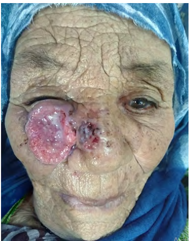 Figure 1: An ulcerative tumor with a seropurulent surface, roughly rounded, 4cm long axis, flesh-colored with beaded border, sitting at the level of the right cheek with extension towards the lower eyelid and the nose.