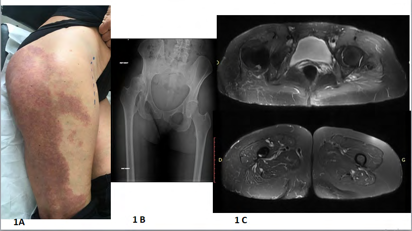 Figure 1: Clinical and orthopedic aspects Case 1. 1A: Porte-wine stain on the thigh and buttock. 1B: Degenerative arthropathy in right hip, leg length discrepancy (4cm). 1C: MRI in T2 fatsat: no deep soft tissue involvement by the VM.