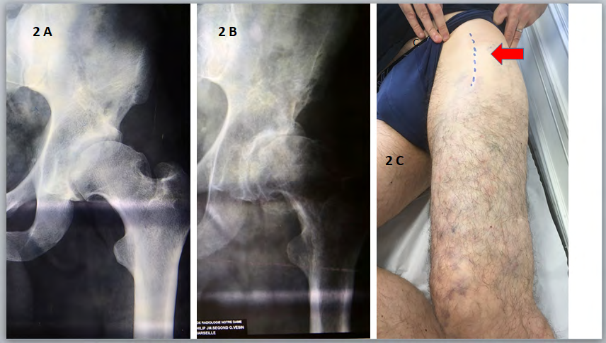 Figure 2: Clinical and orthopedic aspects Case 2. 2A: Bilateral hip dysplasia noted 10 years ago 2B: degenerative arthroplasty in preoperative period 2C: VM with superficial varicose veins and deep tissue involvement, anterior surgical approach. (arrow)