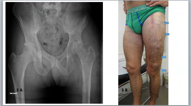 Figure 3: Clinical and orthopedic aspects Case 3 3A: Necrosis of the left femoral head after moderate trauma. 3B: VM with superficial varicose veins and tissue hypertrophy (arrows)