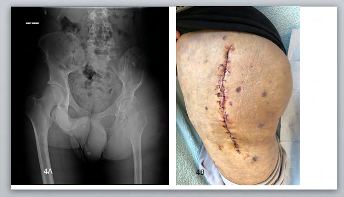 Figure 4: Clinical and orthopedic aspects Case 4. 4A: Degenerative arthropathy, leg length discrepancy (4cm). 4B: VM with superficial varicose veins and significant hypertrophy of the buttock.