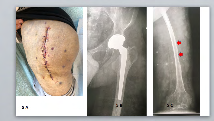 Figure 5: Clinical aspect and radiography of the femoral shaft. 5A: Extensive VM of the buttock, lateral approach 5B: Postoperative control after THR 5C: Abnormal morphology of the femoral shaft (red arrows), phleboliths in the soft tissue. US showed agenesis of the popliteal vein in one patient, normal deep vein for the others.