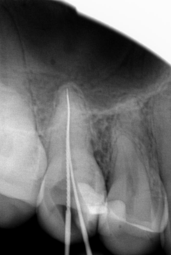 Figure 3: Pre-operative radiograph revealing a tooth 15, with widening of periodontal ligament space and mesio- occlusal composite resin restoration on tooth.