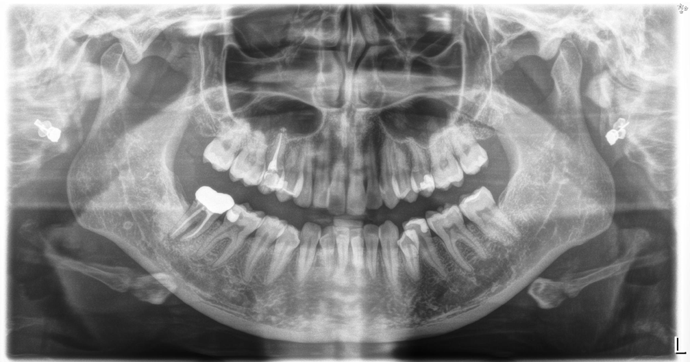 Figure 5: The post-operative radiograph with final obturation.