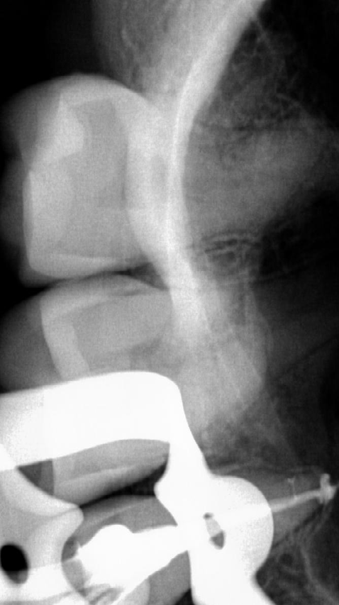 Figure 6: The post-operative radiograph with final obturation and restoration.