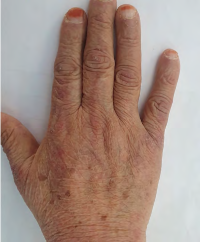 Figure 3: Periungual hyperemia and telangiectasias was present. Gottron papule is also existing and plaques over metacarpophalangeal joints, proximal and distal interphalangeal joints.