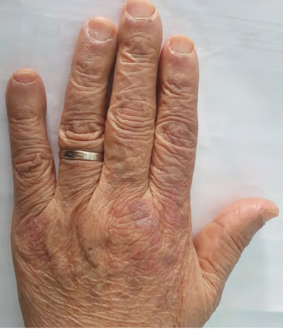 Figure 4: Periungual hyperemia and telangiectasia was present. Gottron papules are also existing and plaques over metacarpophalangeal joints, proximal and distal interphalangeal joints.