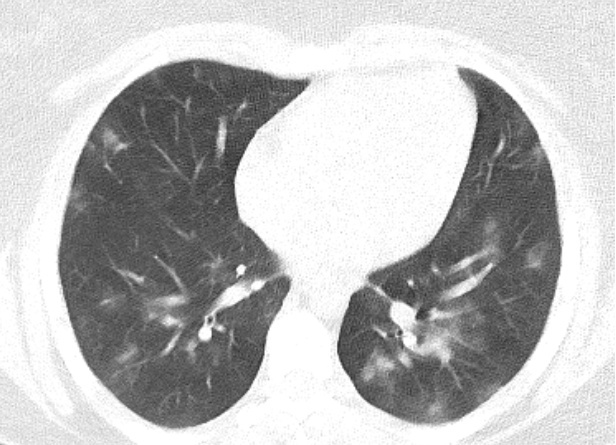 Figure 1: Axial non-enhanced chest CT in a 17-year-old girl (Patient 1 in Table 1) shows multiple areas of patchy-ground opacities and consolidations.