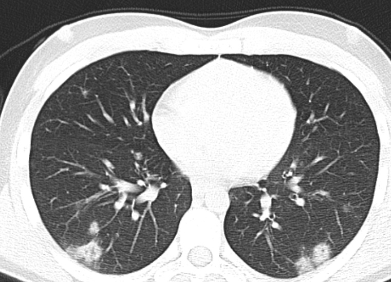 Figure 2: Axial non-enhanced chest CT in a 15-year-old girl (Patient 2 in Table 1) shows patchy-ground opacities and consolidations in the basal segments of the both lungs.