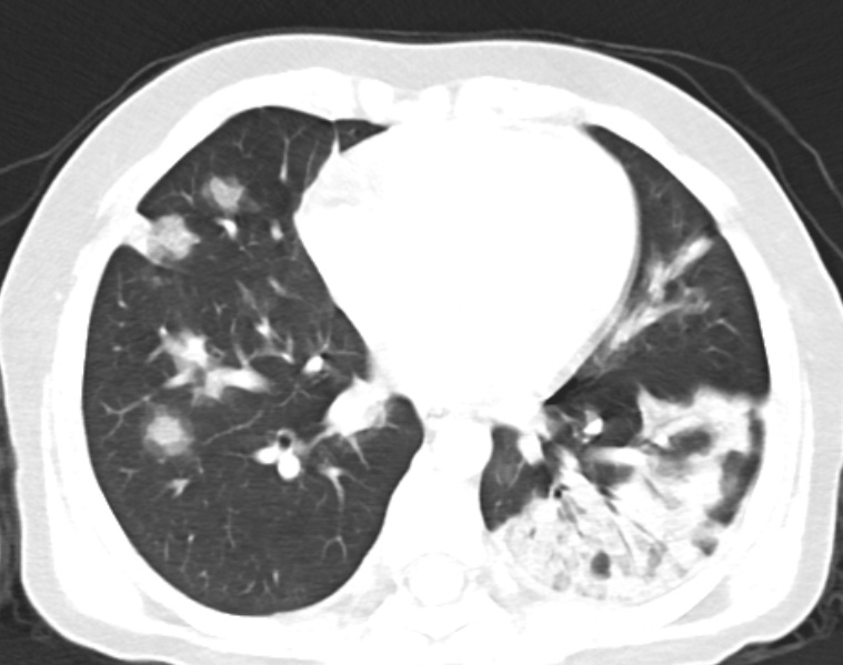 Figure 3: Axial non-enhanced chest CT in a boy aged 9 year 6 months (Patient 8 in Table 1) shows multiple areas of patchy- ground opacities and consolidations. There is also crazy-paving, vascular engorgement, air bronchograms, and pleural thickening in the inferior lobe of the left lung.