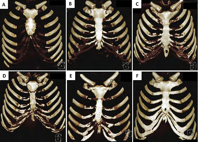 Figure 1: Costal cartilage calcification degree investigated in 3-dimensional volume images. A. <5%, B. 5-25%, C. 25-50%, D. 50-75%, E. 75-100%, F. 100%.