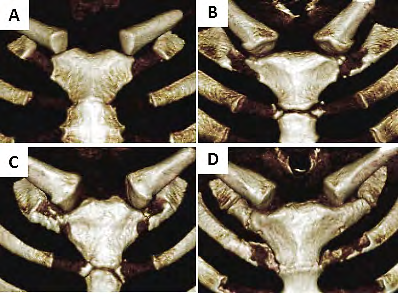 Figure 2: First costal cartilage calcification degree investigated in 3-dimensional volume images. A. No calcification, B. Partial calcification, C. Partial fusion, D. Complete fusion