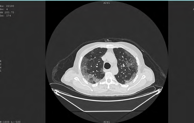 Figure 1: The CT chest of a COVID-19 positive patient shows bilateral peripheral ground glass haze.