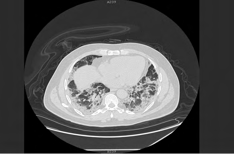 Figure 2: Bi basal peripheral consolidations in a COVID-19 positive patient.