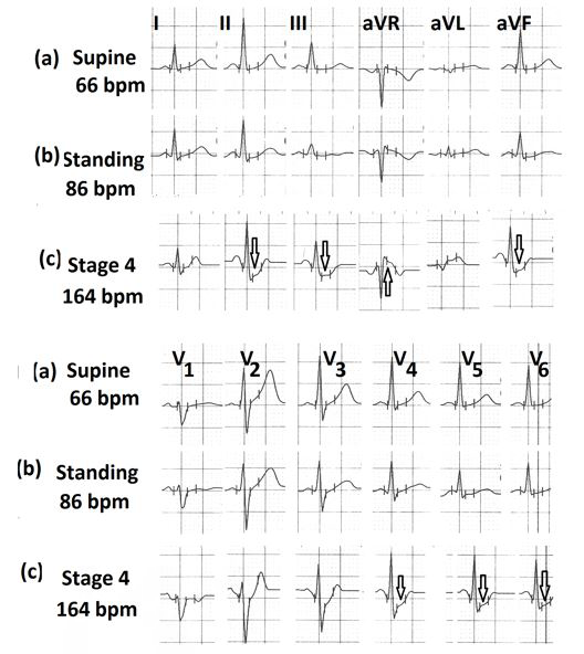 Figure 1: (a) Electrocardiogram in the supine position; (b) In standing position showing mild left axis deviation, (c) During stage 4 of Bruce protocol showing significant ST-segment depression in leads II, III, aVF, V4, V5, and V6 with ST-segment elevation in lead aVR.