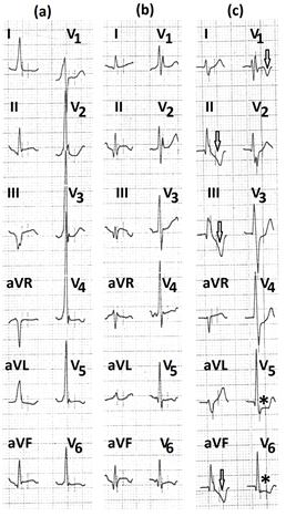Figure 14: Electrocardiograms (a) in supine and standing position, showing pre-excitation; (b) during hyperventilation, showing the disappearance of pre-excitation and appearance of Q wave with ST-segment elevation in leads II, III, aVF; (c) during recovery, showing deep symmetrical T wave inversion in leads II, III, aVF, V1 (marked ⇓) and significant ST-segment depression in leads V5 and V6 (marked ∗).
