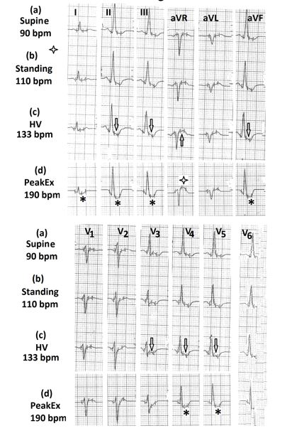 Figure 16: Electrocardiograms (a) in supine position showing mild ST-segment depression and T wave inversion in leads II, III, aVF, V5 to V6; (b) in standing position, showing the mild increase in T wave inversion; (c) during hyperventilation, showing a further increase in ST-segment depression in leads II, III, aVF, V4 to V6 (marked⇓) and ST-segment elevation in lead aVR (marked⇑); (d) during exercise, showing significant ST-segment depression in leads I, II, III, aVF, V4 to V6 (marked∗ ) and ST-segment elevation in lead aVR (marked $$