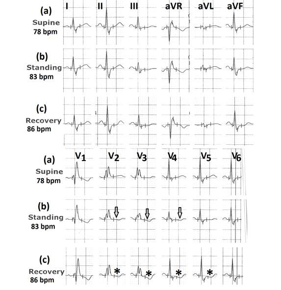 Figure 8: Electrocardiograms (a) in supine position showing RBBB with T wave inversion in lead V1 and positive T waves in leads V2 to V6; (b) in standing position showing T wave inversion in leads V2 to V4 (marked⇓) and horizontal ST segment in leads V5 and V6; (c) during 3rd minute of recovery, showing downsloping ST-segment depression in leads V2 to V5 (marked