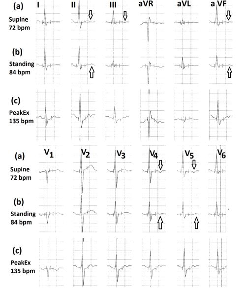 Figure 9: Electrocardiograms (a) in the supine position, showing T wave inversion of less than 1mm in leads II, III,aVF, V4 to V6; (b) in standing position, showing normalization of T waves (marked ⇑); (c) during peak exercise, showing absence of any significant ST-segment depression.