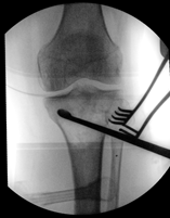 Figure 10: XRs 6-months post-surgical debridement. A: AP XR of knee and proximal tibia. B: AP XR of tibia and healed tibial plafond fracture. C Lateral XR of tibia and healed tibial plafond fracture.