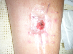 Figure 5: Photo of surgical scar from old pin site infection on acute re-presentation.