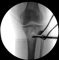 Figure 9: Image intensifier of surgical debridement of proximal tibia osteomyelitis and insertion of antibiotic nail. A-B: Targeted surgical debridement of proximal tibia. B-D: insertion of an antibiotic tibial nail Since the debridement and antibiotics, the wounds have fully healed and the patient has been asymptomatic, regained full function and has returned to work. He has had B A follow-up for over 6 months with normal CRP and an XR showing interval healing of the proximal tibial debridement site (Figure 10).
