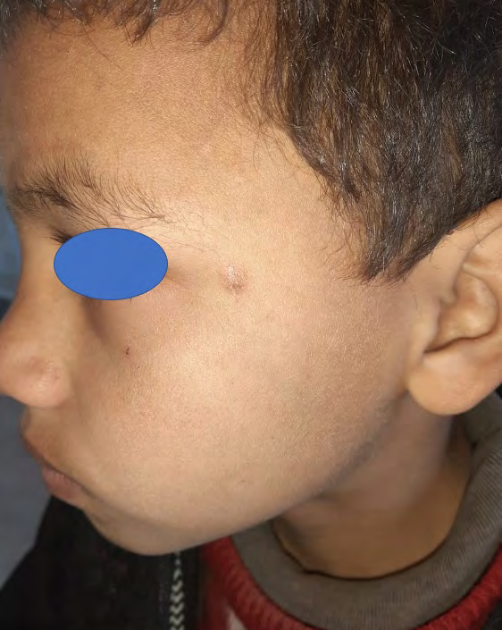 Figure 2: Clinical photo after excision of the nodule.