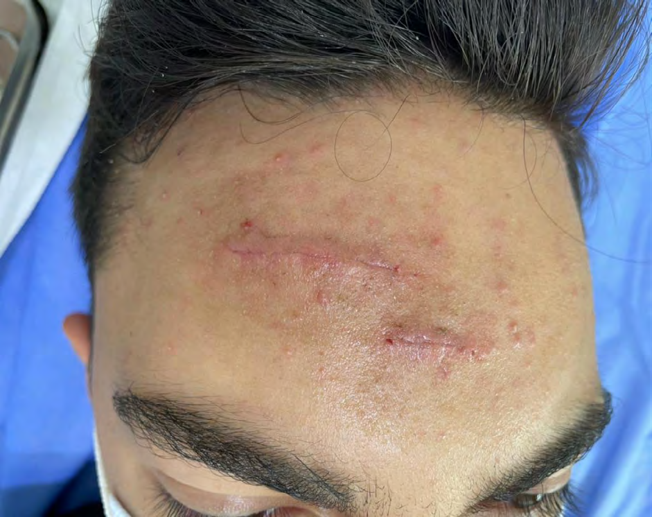 Figure 1: Erythemate use linear scar at the frontal level.