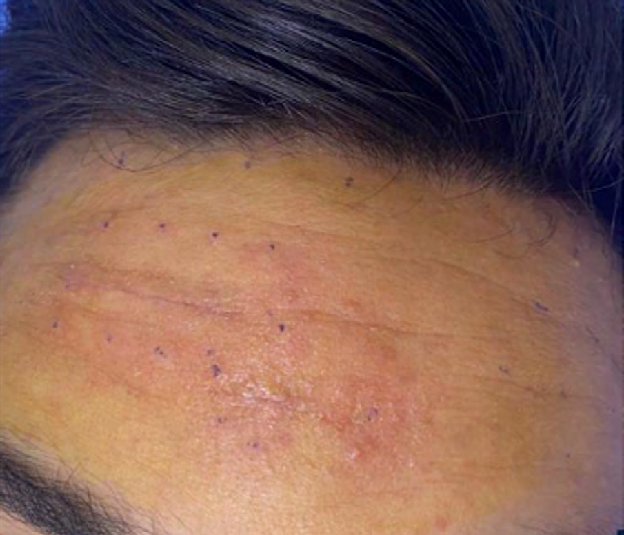 Figure 3: Marking for injection of botulinum toxin.
