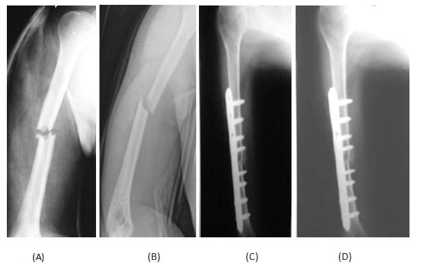 Figure 1: (A) Anteroposterior X-ray showing a case of nonunion in a 32-year-old male with conservatively managed fracture of right humeral shaft. (B) Lateral X-ray showing nonunion of the fracture. (C) Immediate postoperative X-ray showing osteosynthesis and bone grafting. (D) Postoperative X-ray at 16 weeks follow-up visit showing good union at fracture site. In post-operative period, patients were immobilized in a sling, while active and active-assisted range of motion began as soon as tolerated, generally at third day. All patients were followed up at 1-month intervals for the first 6 months after the surgery, then at 2-month intervals for the next 6 months and then at 3-month interval till final follow up visit. Antero-posterior (AP) and lateral radiographs were taken at each follow-up visit. Shoulder and elbow range of motion was assessed at each follow- up visit. Fracture union time, complications and functional outcomes were also recorded. The functional outcome was done by using Modified Constant and Murley Scoring which was recorded before and after surgery and at each follow up [9].