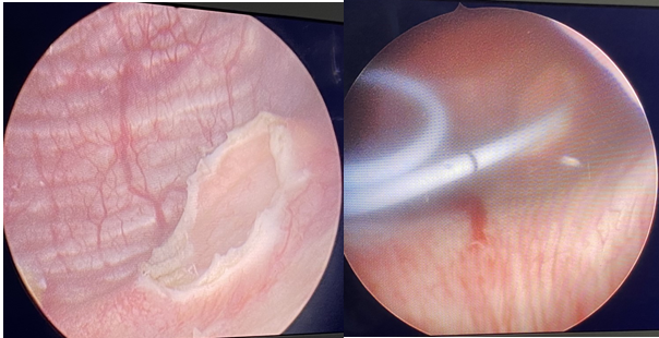Figure 1: Preoperative ultrasound. He was diagnosed as disorders of prostate and was given conservative treatment. However, he came to ER several times, till last visit when he presented with severe lower abdominal pain and urine retention.
