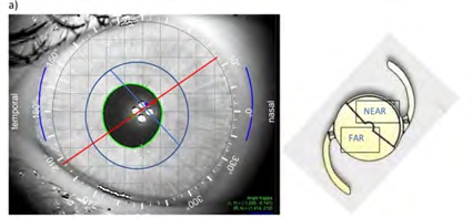 Figure 3: ** Diagram showing the probable position of the Acunx Vario Max lens relative to the pupil in two options in the image obtained from the iTrace analyser. A high value of angle kappa translates into significant decentration of the pupil centre (green cross in the centre of the pupil) in relation to the visual axis (Red Cross). The red line shows the axis of the intraocular lens (the yellow model next to it) and the blue line in the projection divides the lens into parts responsible for vision to far and near distances.