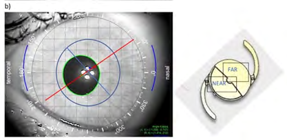 Figure 4: Typical, vertical positioning of the Acunex Vario Max lens in the eye. The upper part is responsible for vision to far distances; the lower part is responsible for vision to near distances.