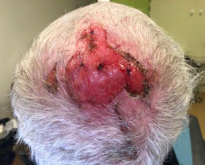 Figure 1: Large granulating ulceration.