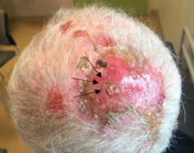 Figure 2: Multiple erosions, pustules (black arrows) and purulent drainage.