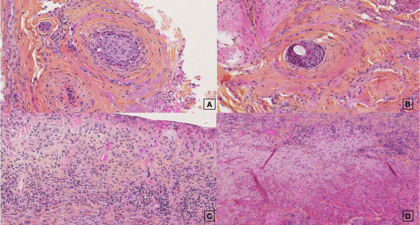Figure 3: Histologic patterns of the lesion (magnification x 100). A. Suppurative folliculitis. B. Atrophic hair follicle. C. Lymphocytic and neutrophilic infiltrate. D. Elastotic derma Erosive pustular dermatosis of the scalp (EPDS) is a subtype of localized amicrobial pustulosis and is considered as a rare inflammatory disease affecting older women and to a lesser extent bald men [1] (sex ratio: 2/1). The triggering factor seems to be a local trauma, mostly iatrogenic, (including surgery, radiotherapy, laser, cryotherapy, and photodynamic therapy) on photo- damaged scalps [1,2,4,5]. It is characterized by sterile painful pustules, erosions and crusts. The diagnosis may be difficult, as it is frequently associated with other frequent sun-related diseases affecting the same area such as AK and cutaneous carcinomas, and because there are no specific histologic features [2,3].