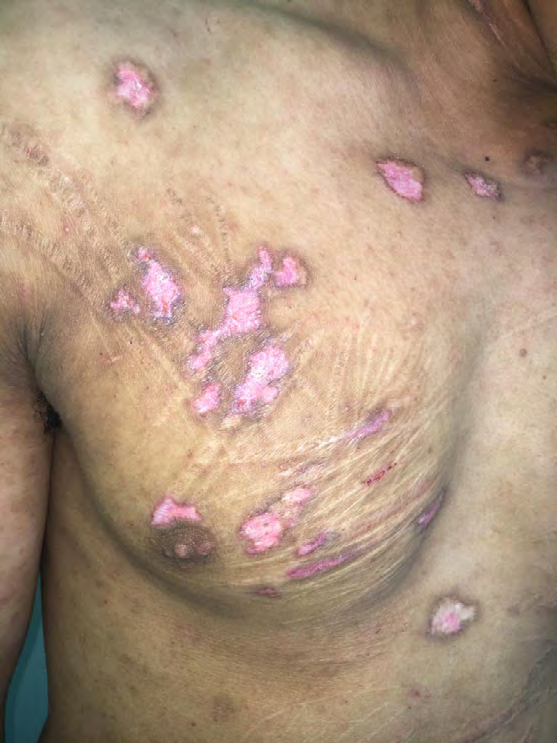 Figure 3: Lesions of discoid lupus on scars illustrating Koebner’s Phenomenon.