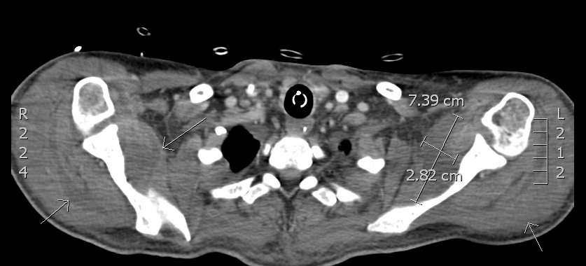 Figure 3: CT-Scan of the upper part of the thorax shows abscess formation in the left and right deltoid and subscapularis muscles (arrows).