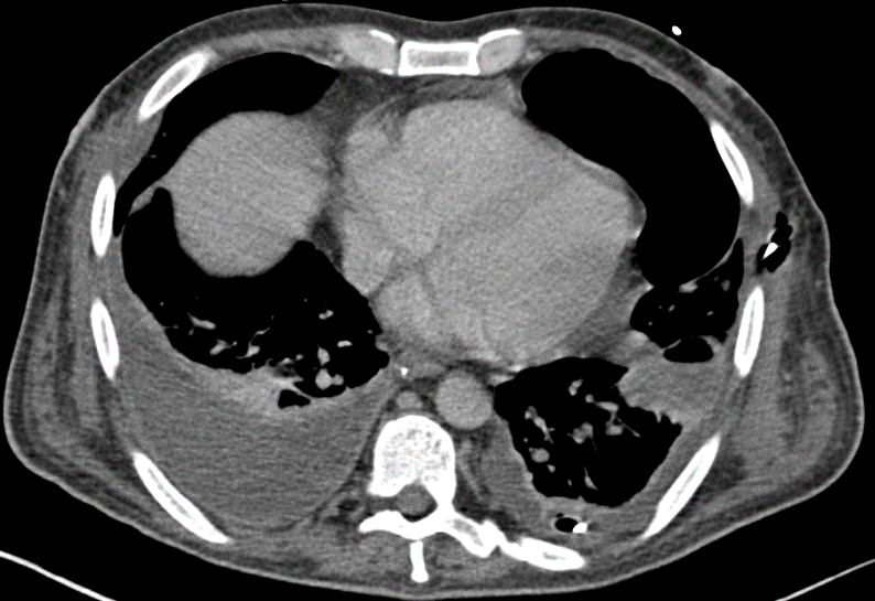 Figure 4: CT-Scan of the Chest shows pleural empyema with abscess formation in the right hemithorax.