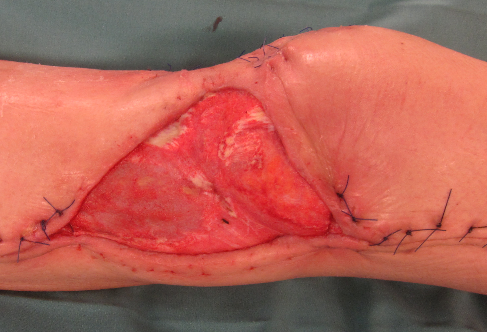 Figure 5: Left Knee joint after multiple surgical debridement including resection of the skin with soft tissues and negative pressure wound therapy.