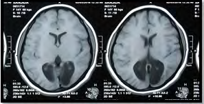 Figure 1: MRI of brain showing Colpocephaly.