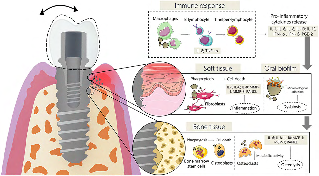 Figure 2: Events following implant placement: Blood clot formation, Granulation tissue formation Provisional matrix formation, Mineralization, Remodeling [2].