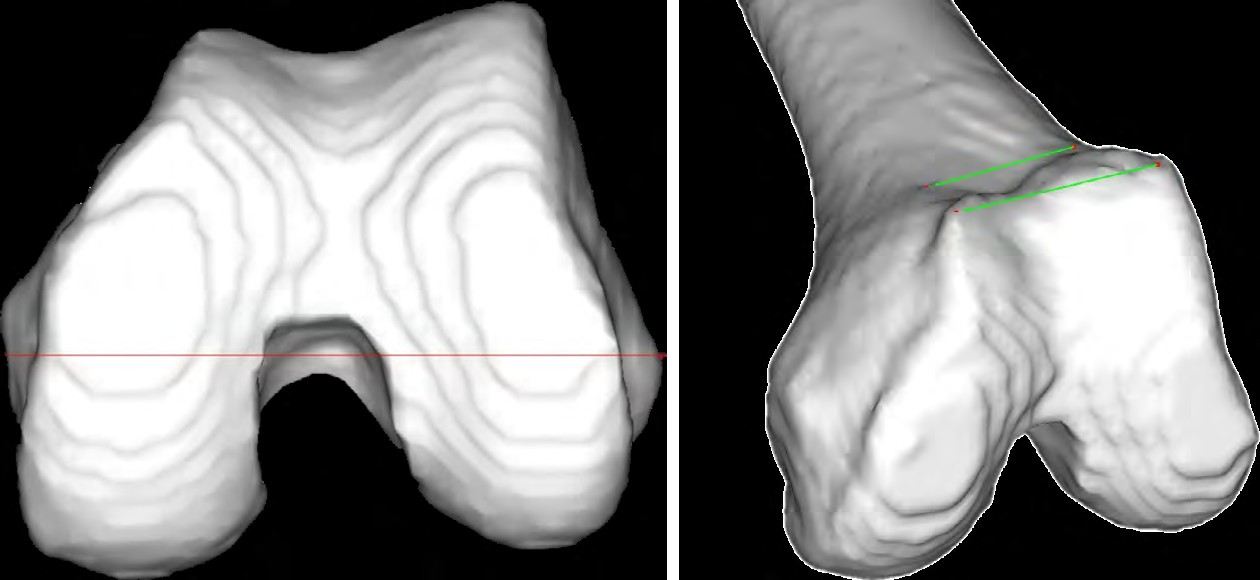 Figure 1: Alternative references for femoral component rotation are depicted. Three-dimensional reconstructed distal femur seen from below and from the front in an oblique direction. sTEA: surgical transepicondylar axis, aTEA: anatomical transepicondylar axis, PCA: posterior condylar axis, APA: trochlear anteroposterior axis, FAT: femoral anterior tangent line, and TAL: trochlear anterior line.