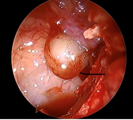 Figure 3: Intraoperative view of the cyst contacting the dehiscent infraorbitary nerve canal through an inferior meatotomy.