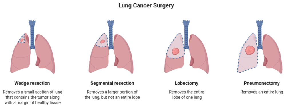 Figure 2: Lung cancer surgery. Source: BioRender Adapted from Mayo Clinic