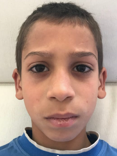 Figure 1: Image showing the rarefaction of the hair density on the head of the eyebrows.