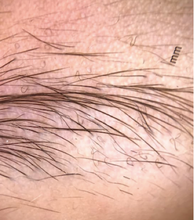 Figure 2: Trichoscopic images showing short broken hairs, corkscrew hairs, zigzag hairs, comma hairs and @ hairs.